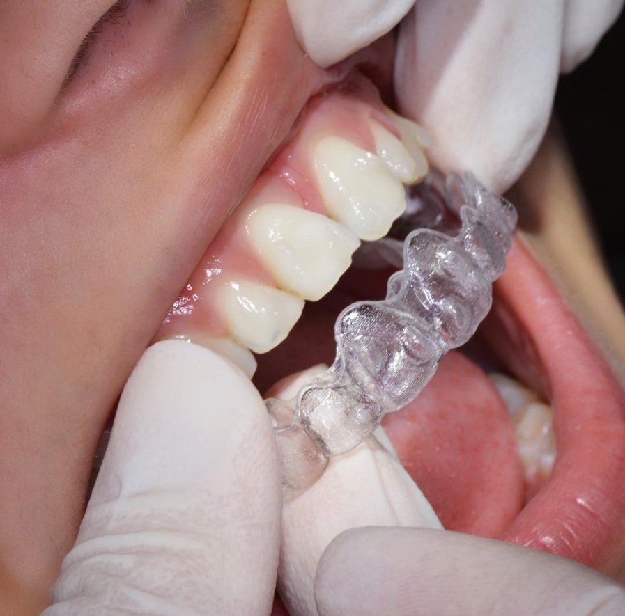 servicio-invisalign